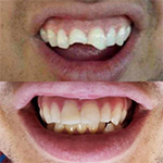 Close up of smile before and after dental treatment