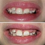Smile before and after treatment from Heber City dentist