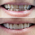 Smile before and after receiving dental treatment